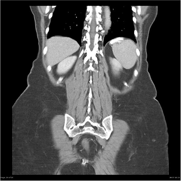 File:Carcinoid tumor of the ileum with metastasis to orbit (Radiopaedia 28165-28425 B 29).jpg