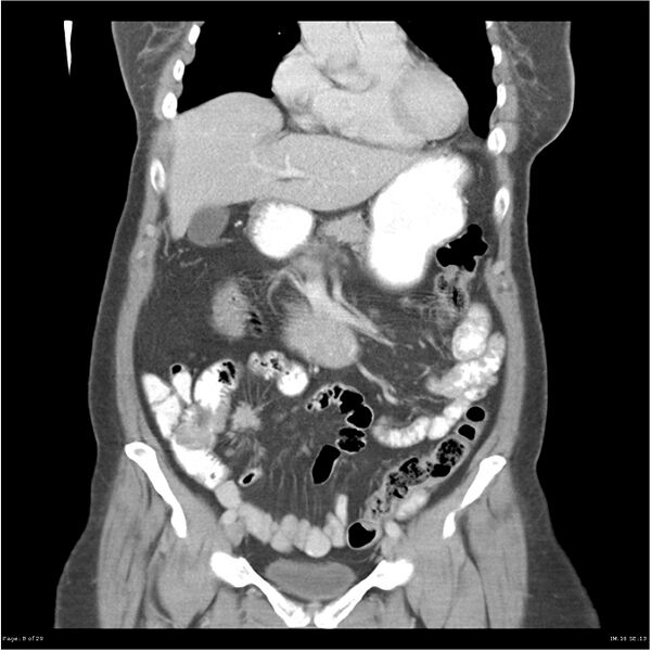 File:Carcinoid tumor of the ileum with metastasis to orbit (Radiopaedia 28165-28425 B 8).jpg