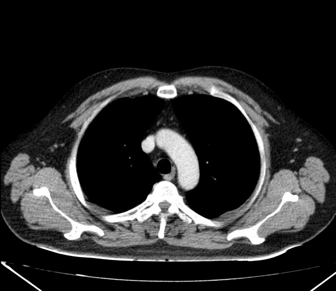 File:Carcinoid tumor with hepatic metastases (Radiopaedia 22651-22670 C 8).jpg