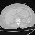 Cardiogenic pulmonary edema (Radiopaedia 29213-29609 Axial lung window 117).jpg