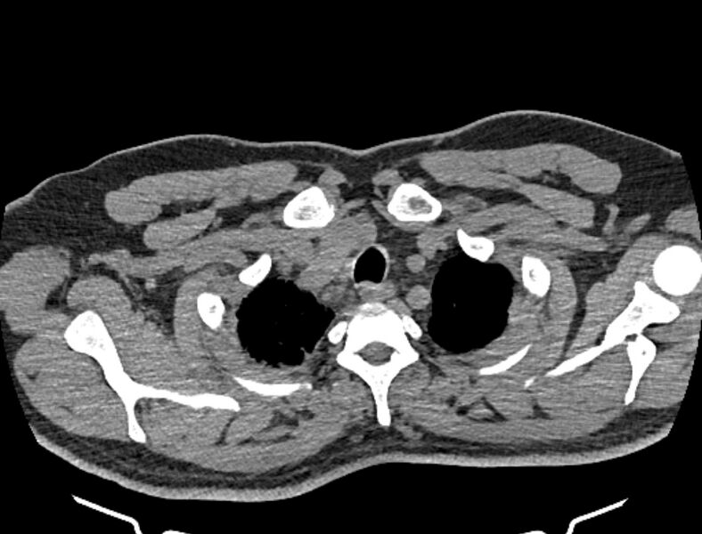 File:Cardiogenic pulmonary edema (Radiopaedia 68180-77678 Axial non-contrast 3).jpg