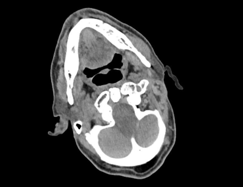 File:Carotid artery pseudoaneurysm (Radiopaedia 84030-99259 Axial non-contrast 3).jpg