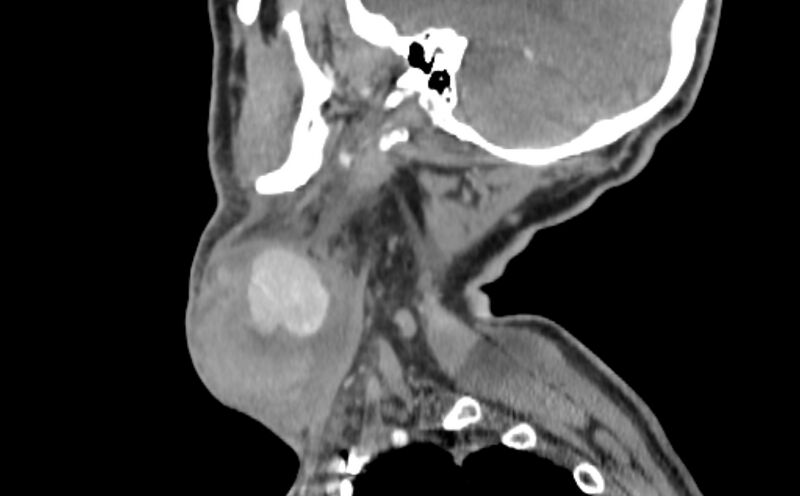 File:Carotid artery pseudoaneurysm (Radiopaedia 84030-99259 E 45).jpg
