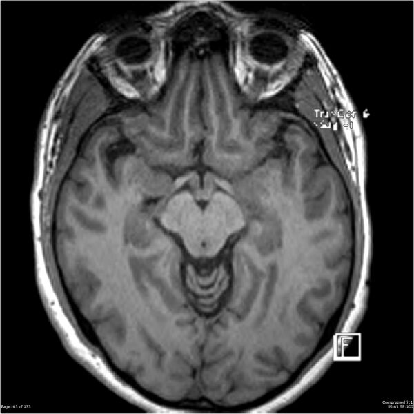 File:Cavernous malformation (cavernous angioma or cavernoma) (Radiopaedia 36675-38237 Axial T1 52).jpg