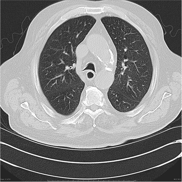 File:Cavitating left lower lobe lesion - squamous cell lung cancer (Radiopaedia 27749-28176 Axial lung window 17).jpg