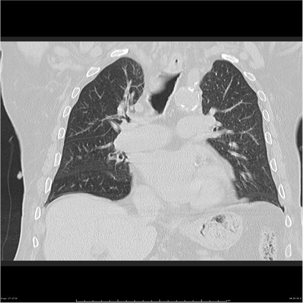 File:Cavitating left lower lobe lesion - squamous cell lung cancer (Radiopaedia 27749-28176 Coronal lung window 27).jpg