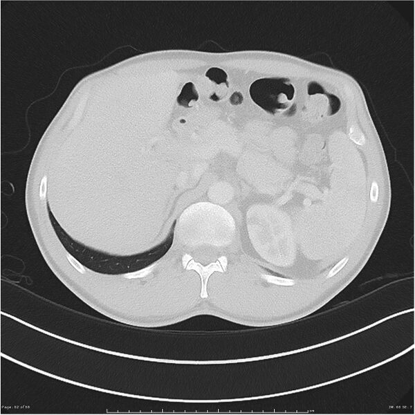 File:Cavitating lung cancer (Radiopaedia 25796-25945 Axial lung window 62).jpg