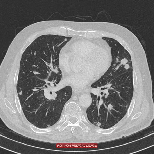 File:Cavitating pulmonary metastases (Radiopaedia 24920-25184 Axial lung window 14).jpg