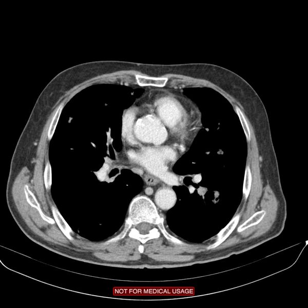 File:Cavitating pulmonary metastases (Radiopaedia 24920-25184 B 15).jpg