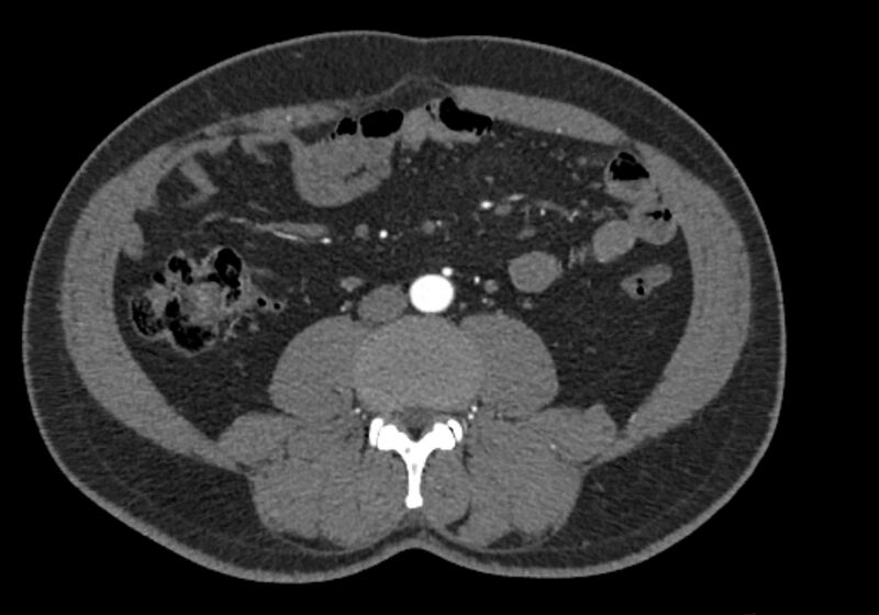 File:Celiac artery dissection (Radiopaedia 52194-58080 A 63).jpg