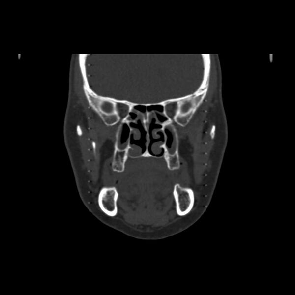 File:Cemento-ossifying fibroma (Radiopaedia 21243-21149 Coronal bone window 12).jpg