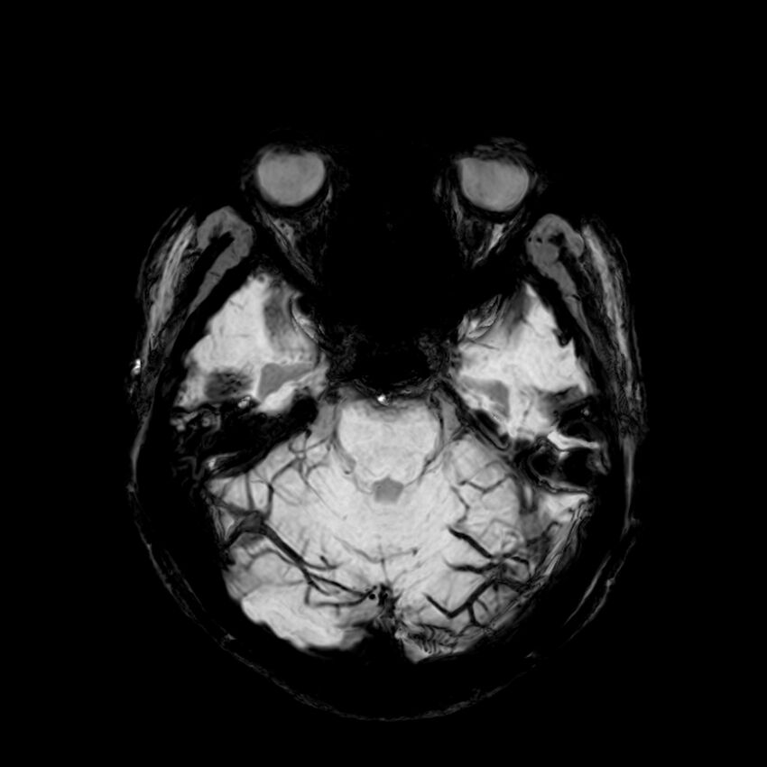 Central neurocytoma (Radiopaedia 79320-92380 Axial SWI 41).jpg