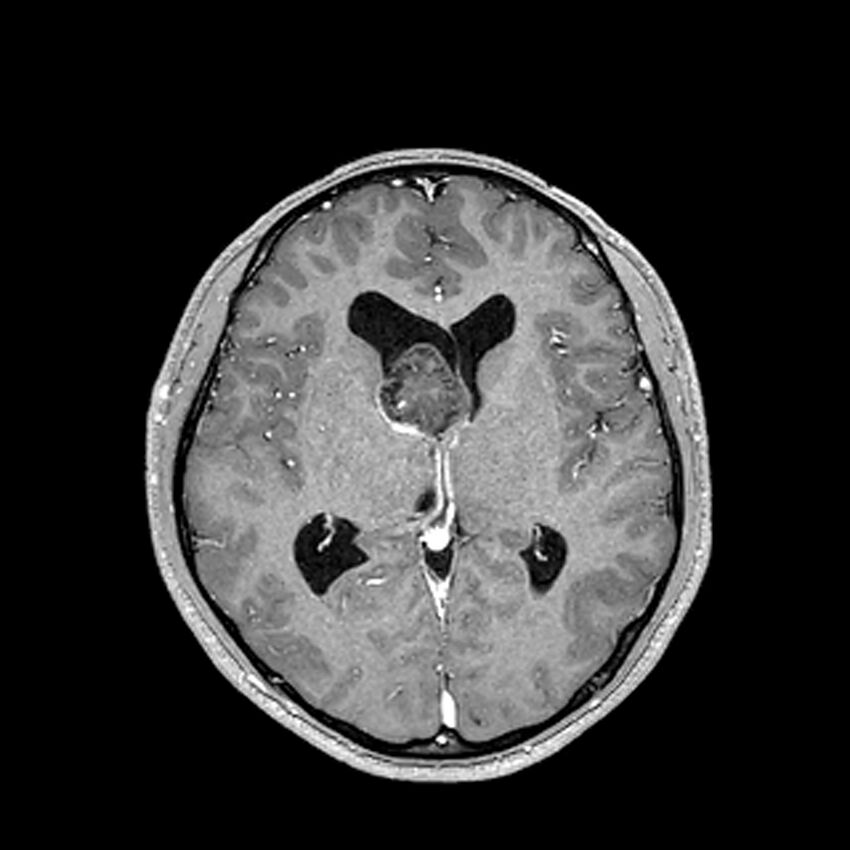 Central neurocytoma (Radiopaedia 79320-92380 Axial T1 C+ 129).jpg