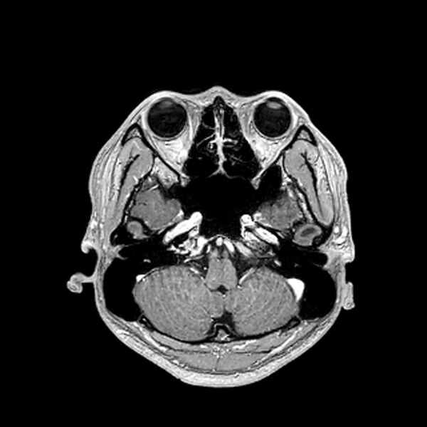 File:Central neurocytoma (Radiopaedia 79320-92380 Axial T1 C+ 68).jpg