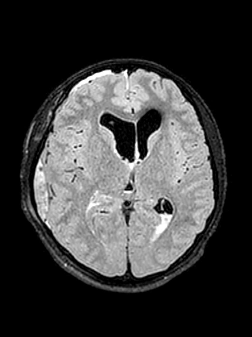 Central neurocytoma (Radiopaedia 79320-92381 Axial FLAIR 86).jpg