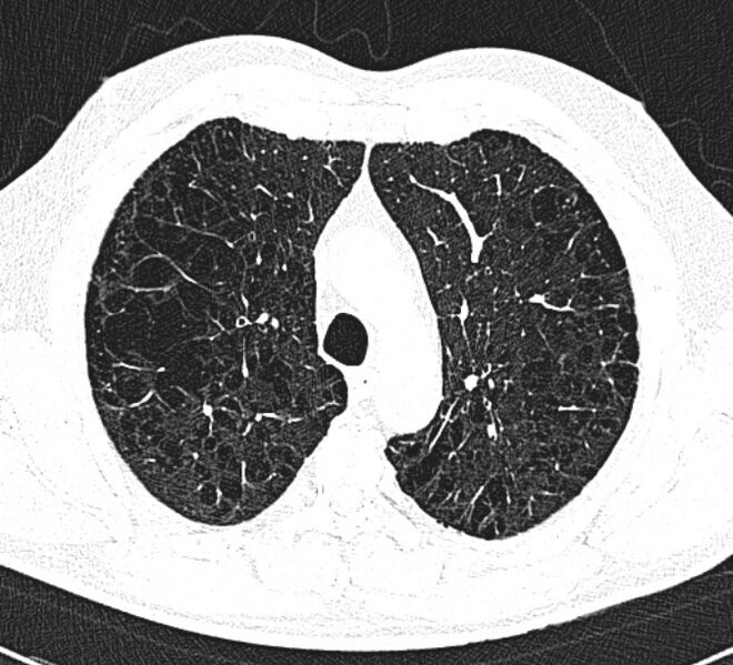 File:Centrilobular pulmonary emphysema (Radiopaedia 26808-26971 Axial lung window 12).jpg