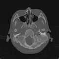 Cerebellar abscess secondary to mastoiditis (Radiopaedia 26284-26413 Axial bone window 26).jpg