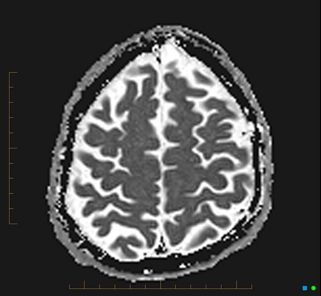 File:Cerebellar gangliocytoma (Radiopaedia 65377-74422 Axial ADC 32).jpg