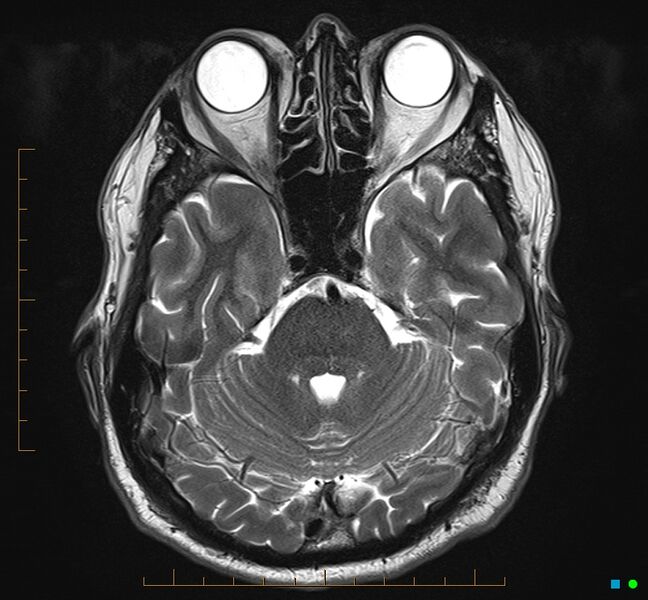 File:Cerebellar gangliocytoma (Radiopaedia 65377-74422 Axial T2 11).jpg