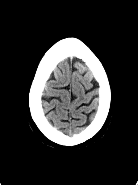 File:Cerebellar infarct due to vertebral artery dissection with posterior fossa decompression (Radiopaedia 82779-97032 Axial non-contrast 27).png