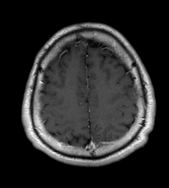 File:Cerebellopontine angle meningioma (Radiopaedia 24459-24764 Axial T1 C+ 20).jpg