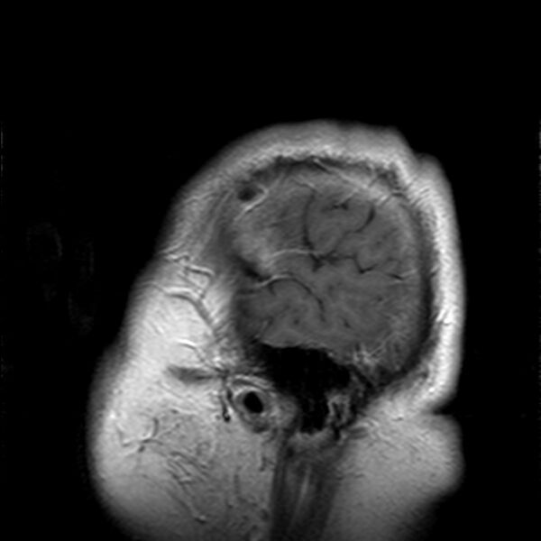 File:Cerebellopontine angle meningioma (Radiopaedia 24459-24764 Sagittal T1 C+ 25).jpg