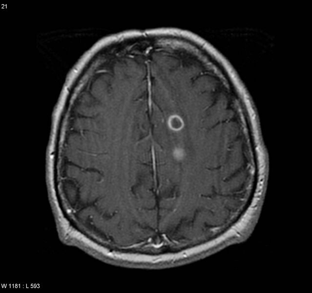 File:Cerebral absceses (Radiopaedia 4933-6838 Axial T1 C+ 1).jpg