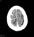 Cerebral abscesses secondary to contusions (Radiopaedia 5201-6967 Axial C+ delayed 11).jpg