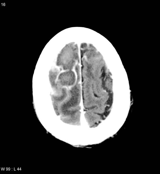 File:Cerebral abscesses secondary to contusions (Radiopaedia 5201-6967 Axial C+ delayed 11).jpg