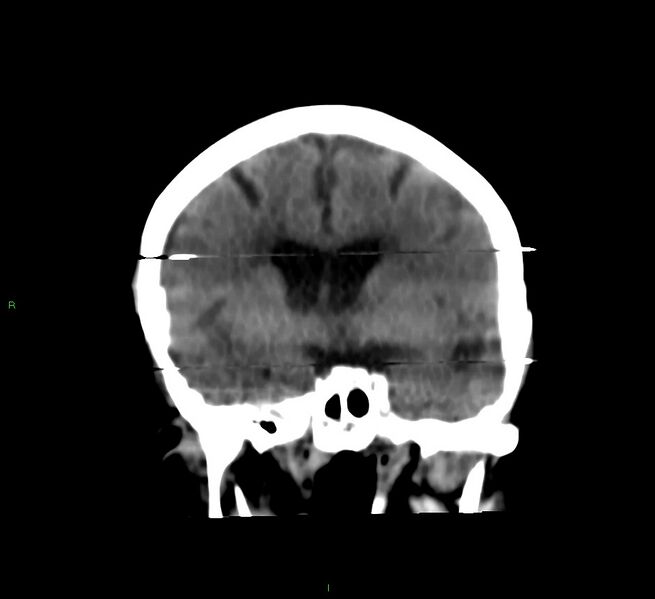 File:Cerebral amyloid angiopathy-associated lobar intracerebral hemorrhage (Radiopaedia 58377-65514 Coronal non-contrast 38).jpg