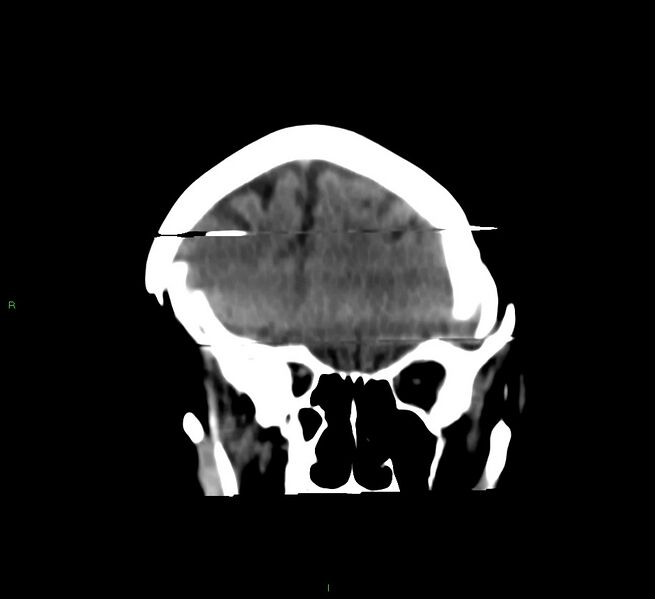 File:Cerebral amyloid angiopathy-associated lobar intracerebral hemorrhage (Radiopaedia 58377-65514 Coronal non-contrast 49).jpg