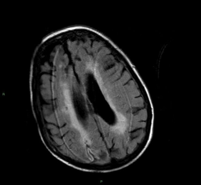 File:Cerebral amyloid angiopathy-associated lobar intracerebral hemorrhage (Radiopaedia 58377-65515 Axial FLAIR 10).jpg