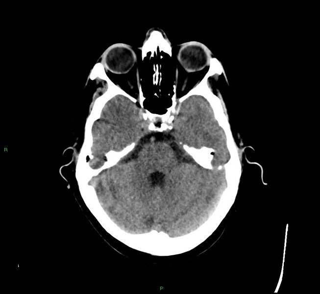 File:Cerebral amyloid angiopathy-associated lobar intracerebral hemorrhage (Radiopaedia 58529-65681 Axial non-contrast 37).jpg
