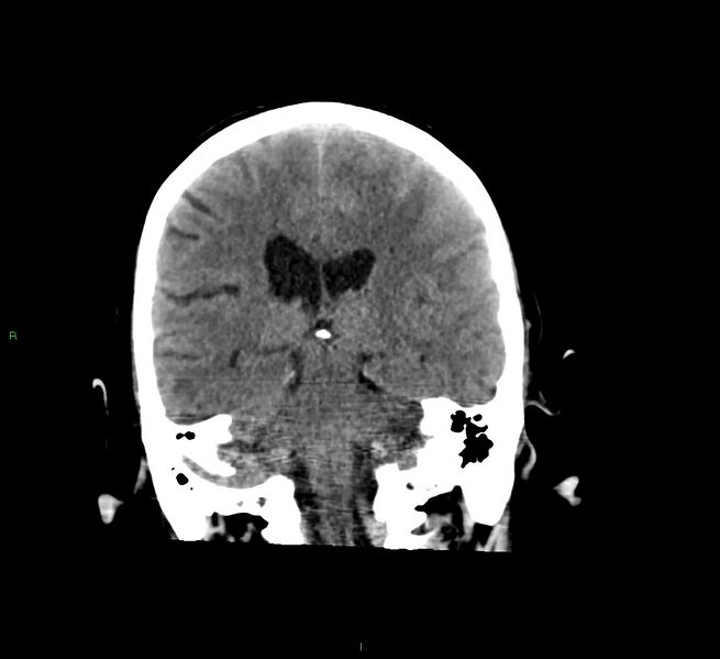 File:Cerebral amyloid angiopathy-associated lobar intracerebral hemorrhage (Radiopaedia 58529-65681 Coronal non-contrast 29).jpg