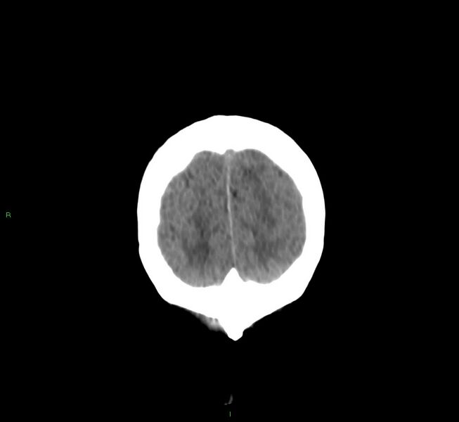 File:Cerebral amyloid angiopathy-associated lobar intracerebral hemorrhage (Radiopaedia 58530-65688 Coronal non-contrast 10).jpg