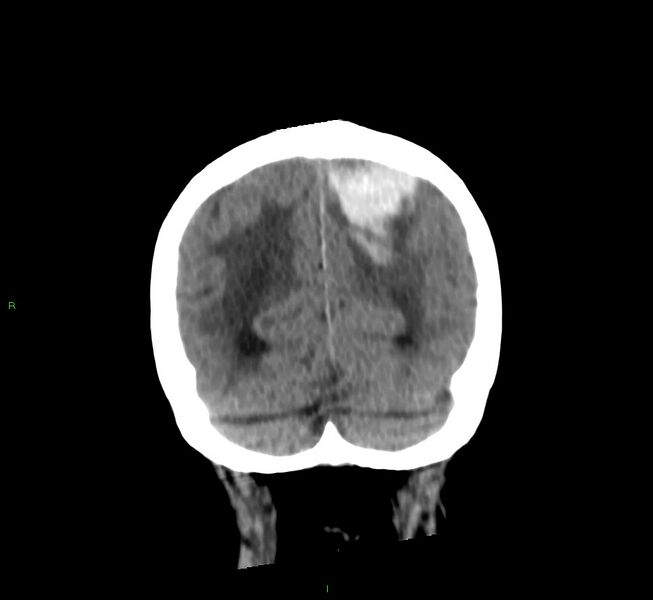 File:Cerebral amyloid angiopathy-associated lobar intracerebral hemorrhage (Radiopaedia 58530-65688 Coronal non-contrast 17).jpg