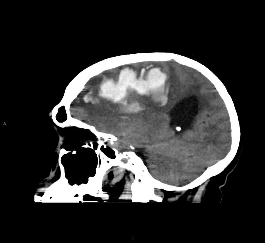 Cerebral amyloid angiopathy-associated lobar intracerebral hemorrhage (Radiopaedia 58560-65723 C 20).jpg