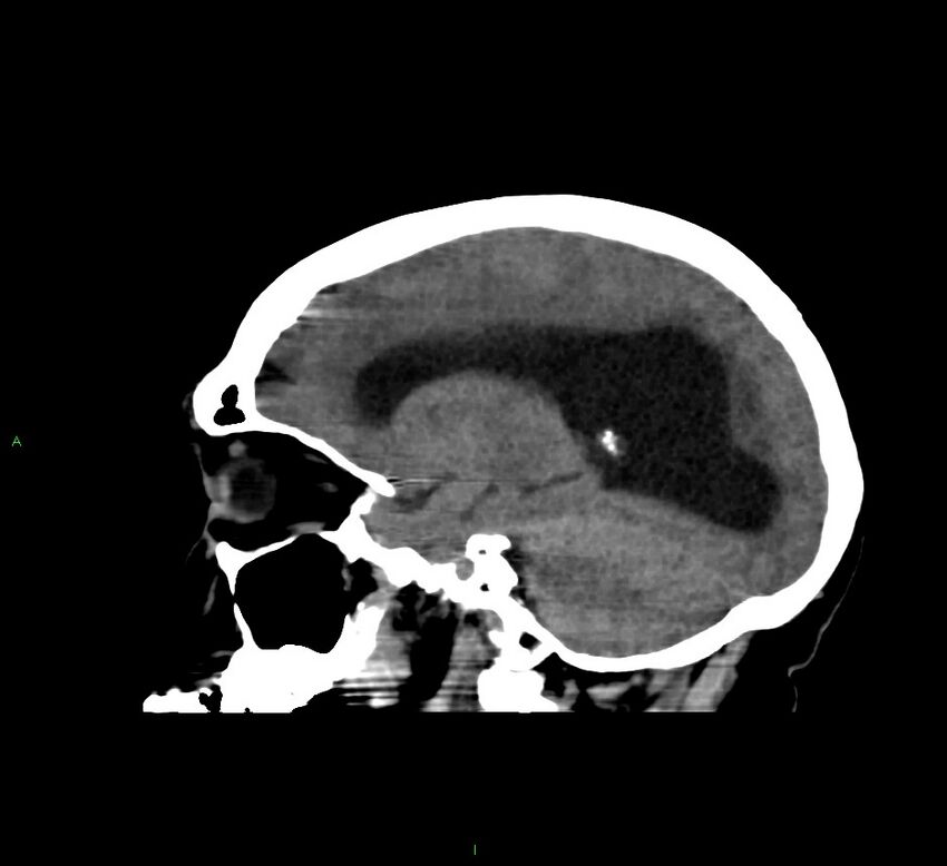 Cerebral amyloid angiopathy-associated lobar intracerebral hemorrhage (Radiopaedia 58560-65723 C 34).jpg