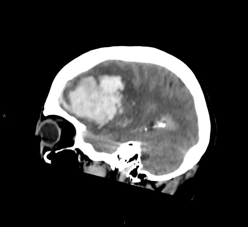 Cerebral amyloid angiopathy-associated lobar intracerebral hemorrhage (Radiopaedia 58752-65973 C 38).jpg