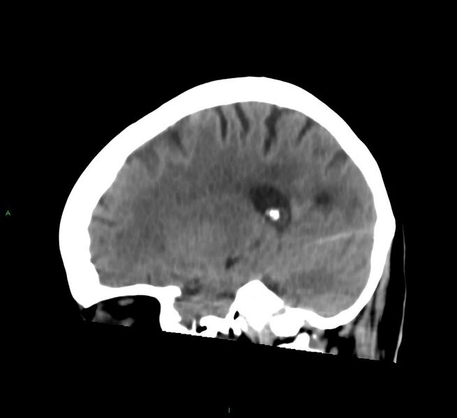 File:Cerebral amyloid angiopathy-associated lobar intracerebral hemorrhage (Radiopaedia 58754-65975 C 16).jpg