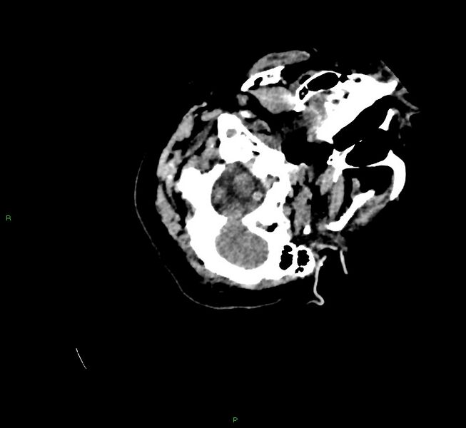 File:Cerebral amyloid angiopathy-associated lobar intracerebral hemorrhage (Radiopaedia 58757-65979 Axial non-contrast 16).jpg