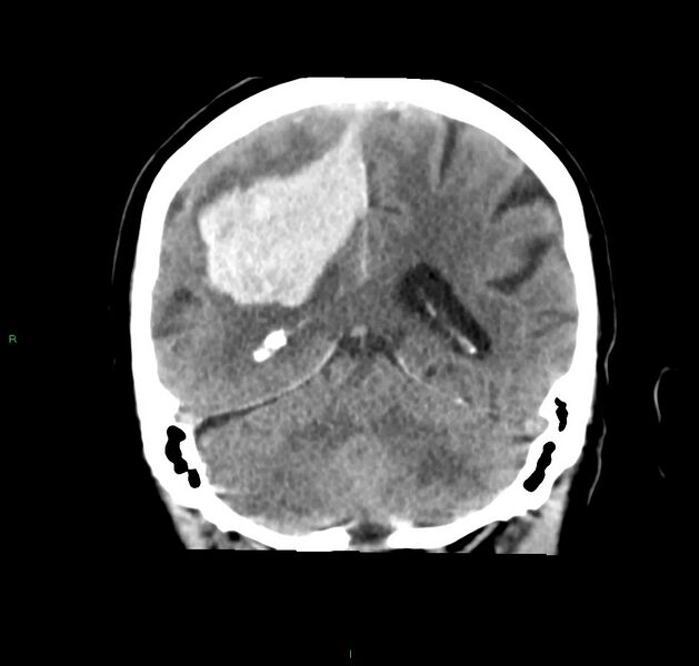 File:Cerebral amyloid angiopathy-associated lobar intracerebral hemorrhage (Radiopaedia 59356-66716 Coronal non-contrast 24).jpg