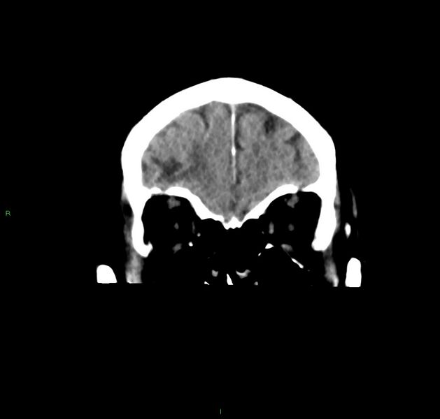 File:Cerebral amyloid angiopathy-associated lobar intracerebral hemorrhage (Radiopaedia 59356-66716 Coronal non-contrast 53).jpg