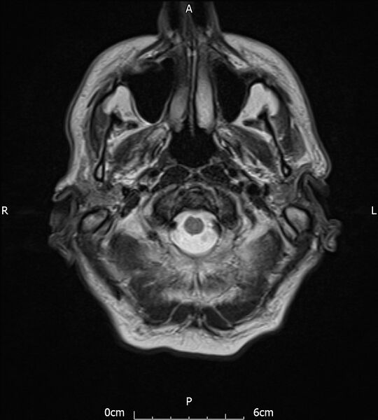 File:Cerebral amyloid angiopathy related inflammation (Radiopaedia 72772-83415 Axial T2 2).jpg