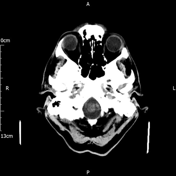 File:Cerebral amyloid angiopathy related inflammation (Radiopaedia 72772-83480 Axial non-contrast 3).jpg