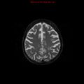 Cerebral and orbital tuberculomas (Radiopaedia 13308-13311 Axial T2 16).jpg