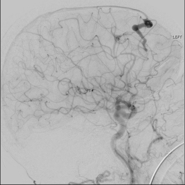 File:Cerebral arteriovenous malformation with lobar hemorrhage (Radiopaedia 44725-48513 LT CCA IC 37).png