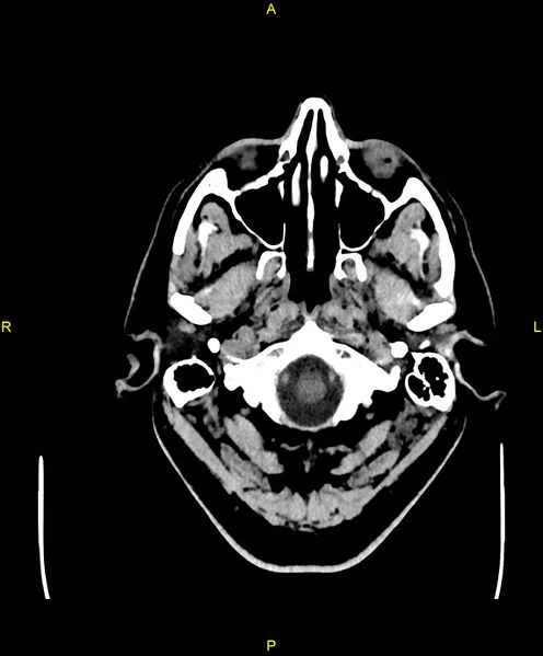 File:Cerebral autosomal dominant arteriopathy with subcortical infarcts and leukoencephalopathy (CADASIL) (Radiopaedia 86108-102051 Axial non-contrast 3).jpg