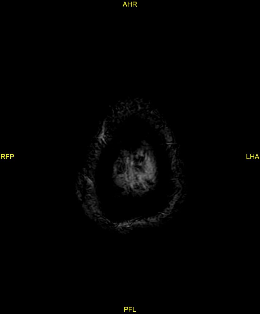 Cerebral autosomal dominant arteriopathy with subcortical infarcts and leukoencephalopathy (CADASIL) (Radiopaedia 86108-102054 Axial SWI 104).jpg