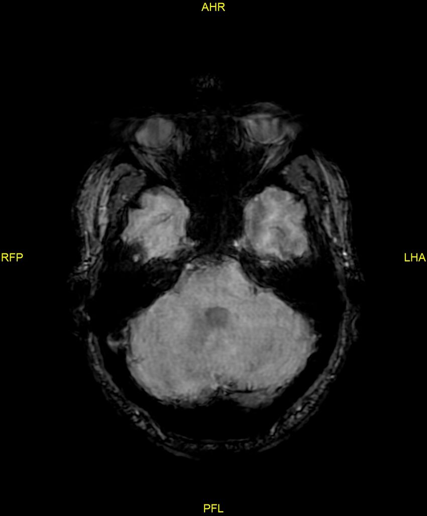 Cerebral autosomal dominant arteriopathy with subcortical infarcts and leukoencephalopathy (CADASIL) (Radiopaedia 86108-102054 Axial SWI 32).jpg